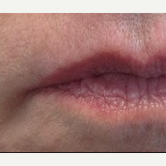 55-64 year old woman treated with Restylane Silk after 3370886