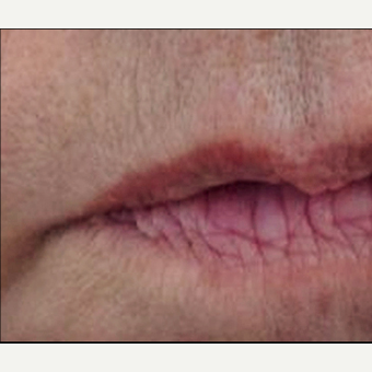 55-64 year old woman treated with Restylane Silk before 3370886