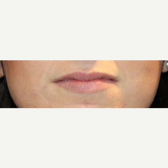18-24 year old woman treated with Volbella before 3663966