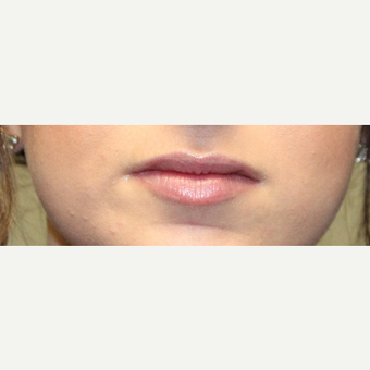 18-24 year old woman treated with Volbella after 3663966