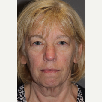 55-64 year old woman treated with Brow Lift before 3286780