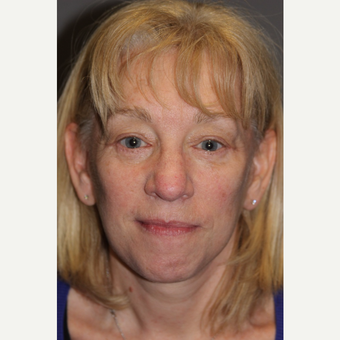 55-64 year old woman treated with Brow Lift after 3286780