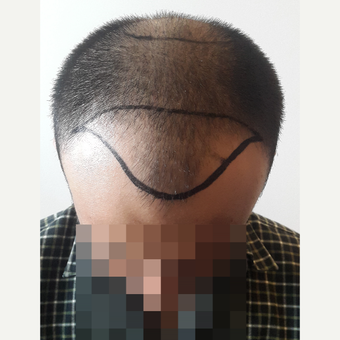 18-24 year old man treated with FUE Hair Transplant before 3729948