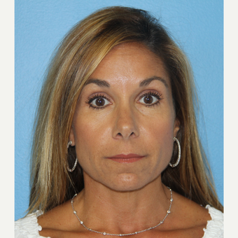 46 year old woman treated with Exilis after 2655817