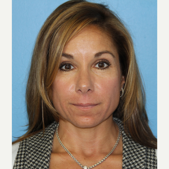 46 year old woman treated with Exilis before 2655817