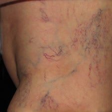 Spider Vein Sclerotherapy Results After Several Sessions before 914997