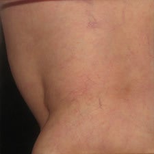 Spider Vein Sclerotherapy Results After Several Sessions after 914997