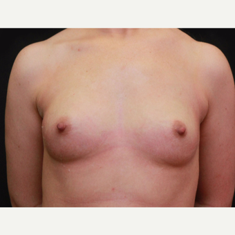 25-34 year old woman treated with Breast Augmentation before 3167726