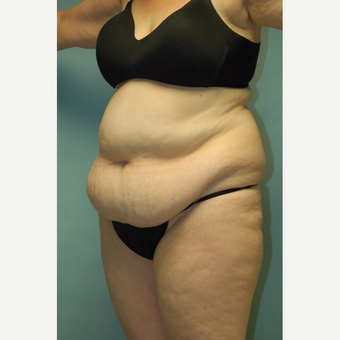 58 year old woman, 5'6", 188 lbs. four months after lipoabdominoplasty before 3771618