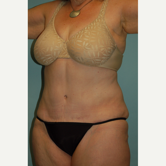 58 year old woman, 5'6", 188 lbs. four months after lipoabdominoplasty after 3771618
