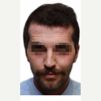 35-44 year old man treated with Organic Hair Transplant after 3280156