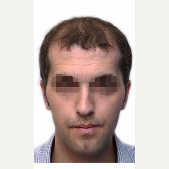35-44 year old man treated with Organic Hair Transplant before 3280156