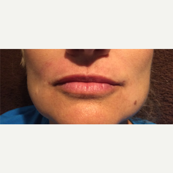 45-54 year old woman treated with Lip Augmentation after 3467125