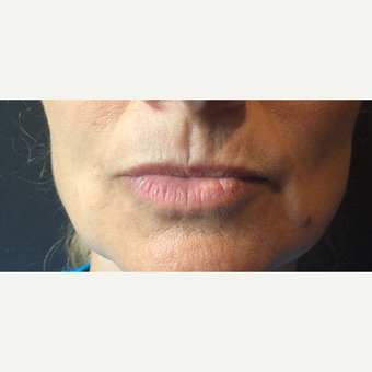 45-54 year old woman treated with Lip Augmentation before 3467125