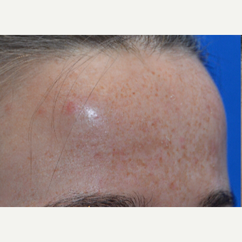 Results from one Facial treatment before 3496488