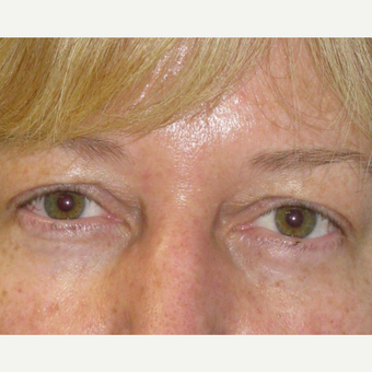 45-54 year old woman treated with Eyelid Surgery before 3253512