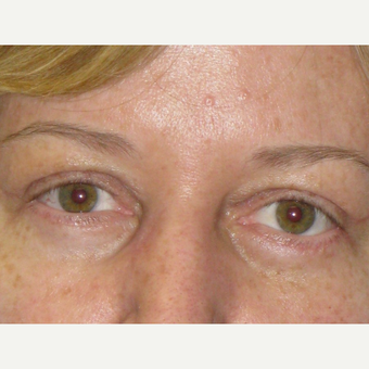 45-54 year old woman treated with Eyelid Surgery after 3253512