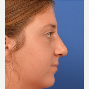 18-24 year old woman treated with Rhinoplasty after 3220381