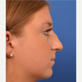 18-24 year old woman treated with Rhinoplasty before 3220381