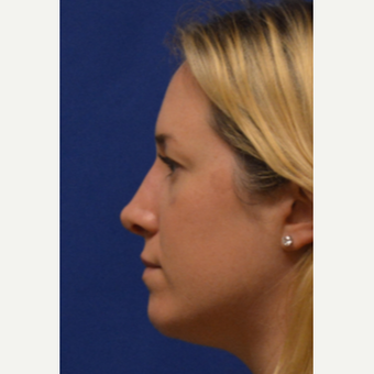 25-34 year old woman treated with Rhinoplasty after 3125042
