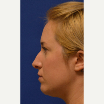 25-34 year old woman treated with Rhinoplasty before 3125042