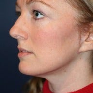 35-44 year old woman treated with Facelift after 1564065