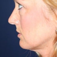 35-44 year old woman treated with Facelift before 1564065
