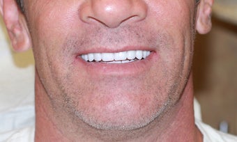 40 year old Male treated with All-on-4 Dental Implant Procedure after 1053417