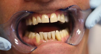 40 year old Male treated with All-on-4 Dental Implant Procedure before 1053417