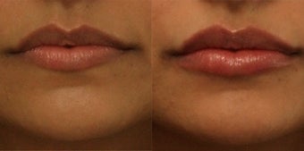 Lip Augmentation before 910728
