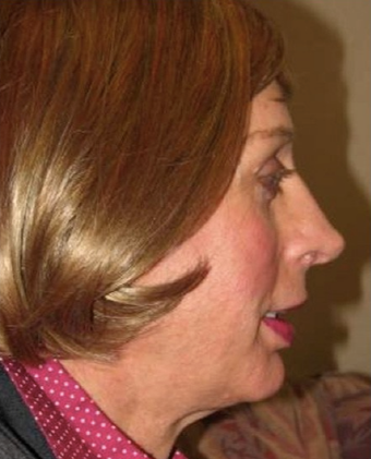 45-54 year old woman treated with Facial Feminization Surgery after 2052743