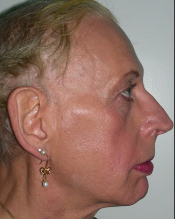 45-54 year old woman treated with Facial Feminization Surgery before 2052743