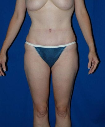 35-44 year old woman treated with SAFELipo after 3126302