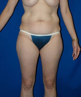 35-44 year old woman treated with SAFELipo before 3126302