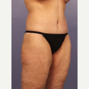 45-54 year old woman treated with Body Lift after 3666067