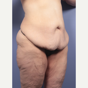45-54 year old woman treated with Body Lift before 3666067