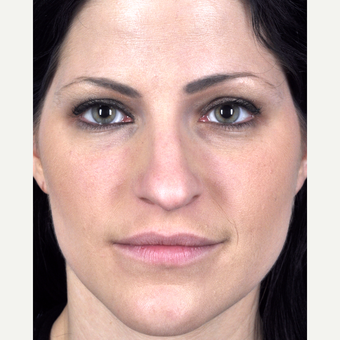 25-34 year old woman treated with Rhinoplasty before 3815687
