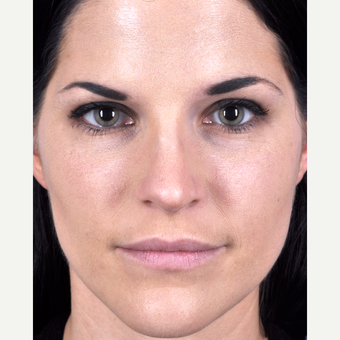 25-34 year old woman treated with Rhinoplasty after 3815687