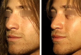 22 year-old male with a nose he feels is “too big” in proportion to the rest of his facial features. 666469
