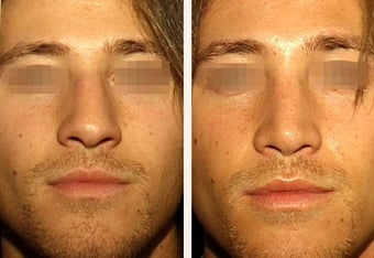 22 year-old male with a nose he feels is “too big” in proportion to the rest of his facial features. before 666469