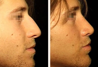 22 year-old male with a nose he feels is “too big” in proportion to the rest of his facial features. after 666469