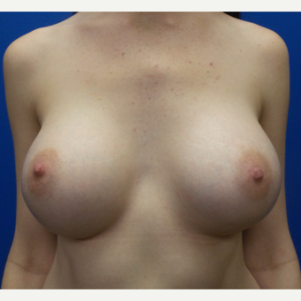 18-24 year old woman treated with Breast Augmentation after 3288452