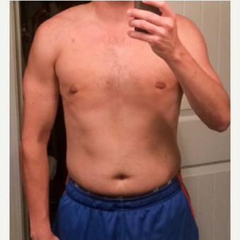 Gynecomastia treatment. after 3486933