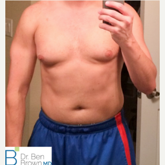 Gynecomastia treatment. before 3486933