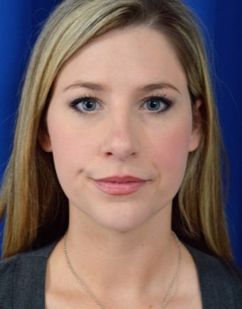 25-34 year old woman treated with Rhinoplasty after 3271480