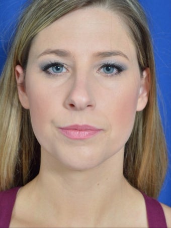 25-34 year old woman treated with Rhinoplasty before 3271480
