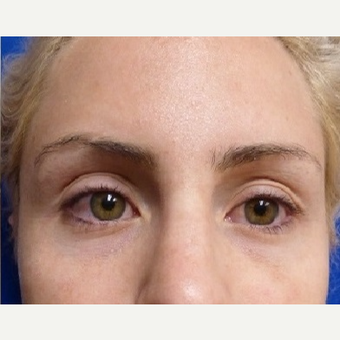 25-34 year old woman treated with Restylane after 3715427