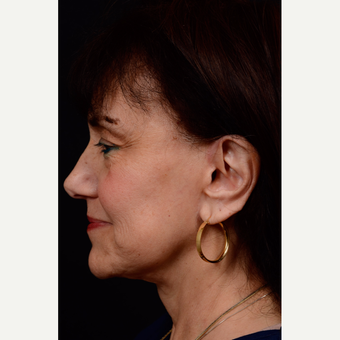 55-64 year old woman treated with Neck Lift and Face Lift after 3776491