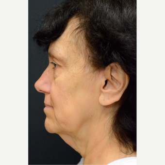 55-64 year old woman treated with Neck Lift and Face Lift before 3776491