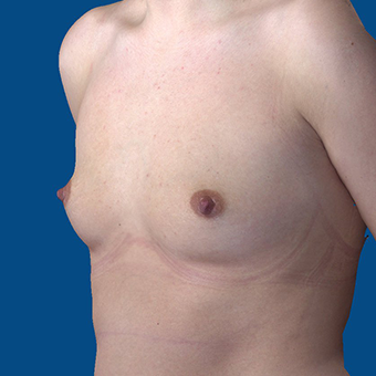 18-24 year old woman treated with Breast Augmentation before 3732373